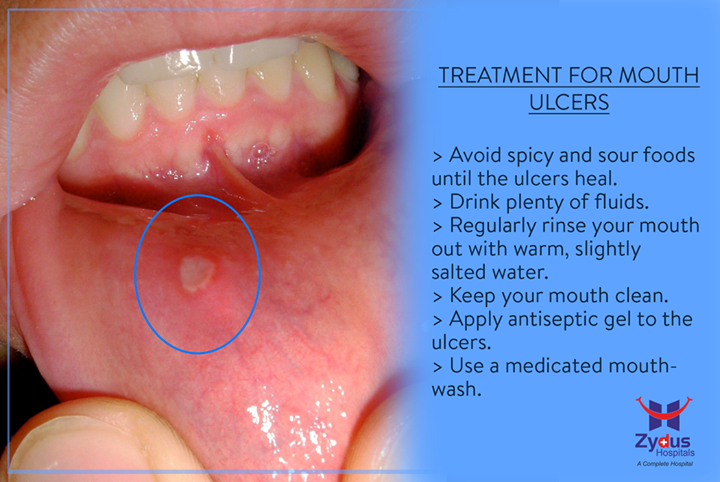 Suffering from mouth ulcer? Here are some simple steps for relief..

#ZydusHospitals #GoodHealth #Ahmedabad