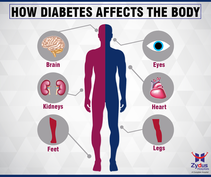 Diabetes can affect a number of areas in the body. The eyes, arteries, kidneys, nervous system and blood vessels can all be affected with it.

#HealthCare #ZydusHospitals #Ahmedabad