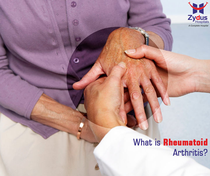 #RheumatoidArthritis affects joints on both sides of the body, such as both hands, both wrists, and both knees. This symmetry helps to set it apart from other types of arthritis.

RA can also affect the skin, eyes, lungs, heart, blood, or nerves.

#ZydusCares #HealthCare #ZydusHospital #Ahmedabad