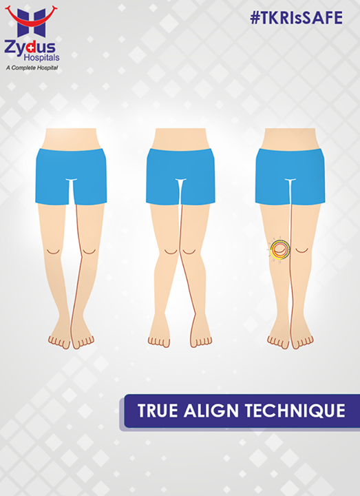 Anyone who’s suffering knee pain from long and is still reliable on the pill it’s high time to take the next step & opt for total knee replacement. Find out yourself why it is safe when it’s done at Zydus Hospitals !

#TrueAlign #KneeReplacement #ZydusHospitals #Ahmedabad