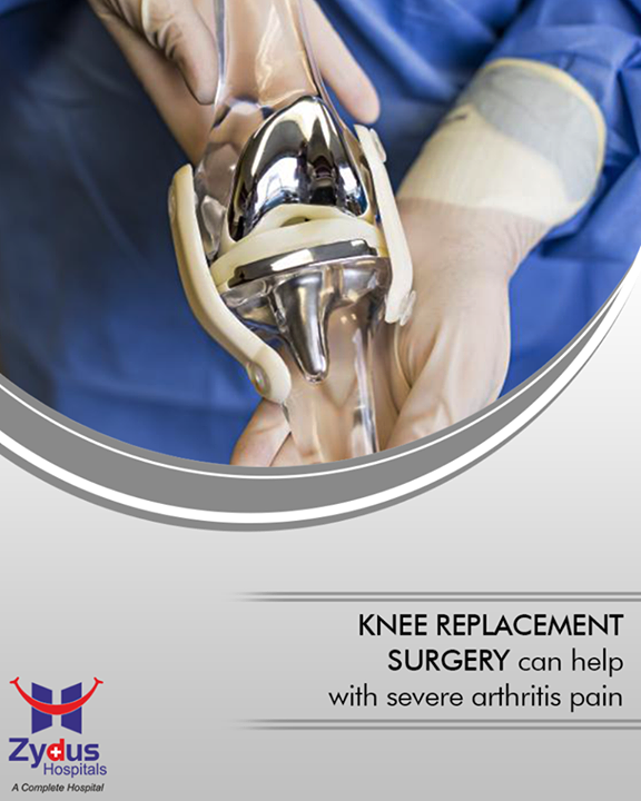 Knee replacement surgery can help with severe arthritis pain and may help you walk easier too. Wear and tear, illness, or a knee injury can damage the cartilage around your knee bones and keep the joint from working well. 

#TKRIsSafe #TrueAlignTechnique #HealthCare #ZydusCares #ZydusHospitals #Ahmedabad