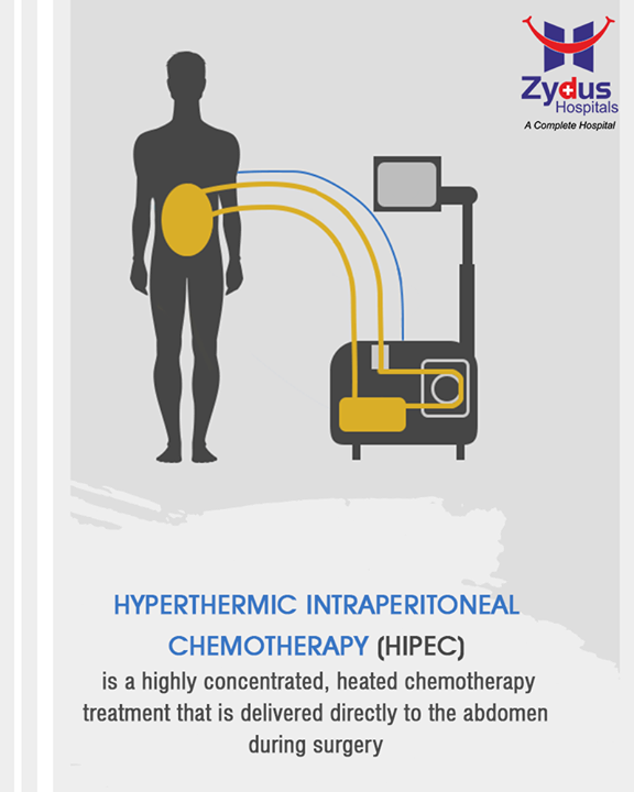 This treatment is designed to place chemotherapy in the tissues where the cancer cells have developed and spread in order to expose every cell to the medication. Zydus Hospitals is the only hospital in Gujarat offering innovative solutions for Cancer treatment.

#HyperthermicIntraperitonealChemotherapy #HIPEC #HealthyYou #ZydusHospitals #ZydusCare #StayHealthy #Ahmedabad