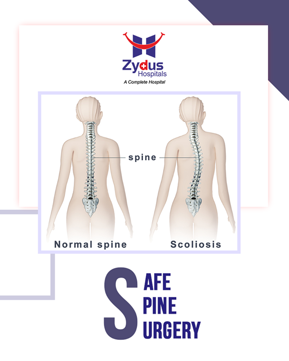Scoliosis, an abnormal curvature of the spine, most often manifests itself in children during growth. It can be treated surgically.

#SafeSpineSurgeries #ZydusHospitals #ZydusCare #StayHealthy #Ahmedabad
