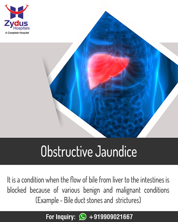 :: Obstructive Jaundice ::

#LiverCare #Hepatitis #HealthyLiver #HealthyYou #ZydusHospitals #ZydusCare #StayHealthy #Ahmedabad