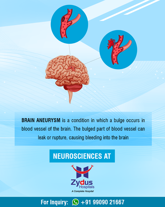 With the advancement in Medical sciences, brain aneurysm is now curable.

#ZydusHospitals #StayHealthy #Ahmedabad #GoodHealth