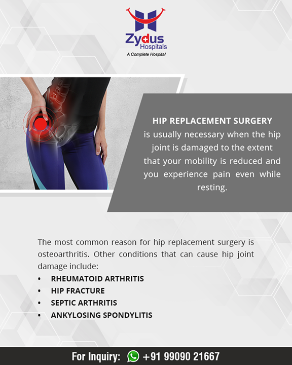 Reasons that can cause hip joint damage

#HipReplacement #HumanHip #ZydusHospitals #Ahmedabad #GoodHealth #WeCare