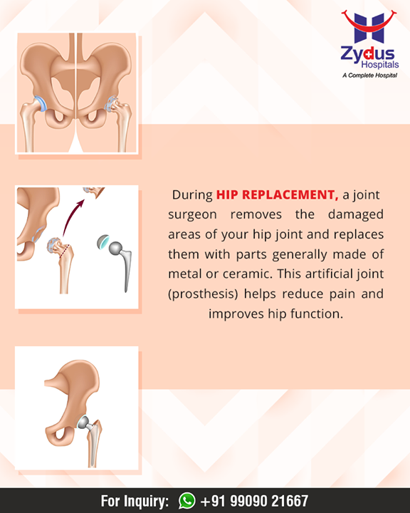 Facts about #HipReplacement!

#HumanHip #ZydusHospitals #Ahmedabad #GoodHealth #WeCare