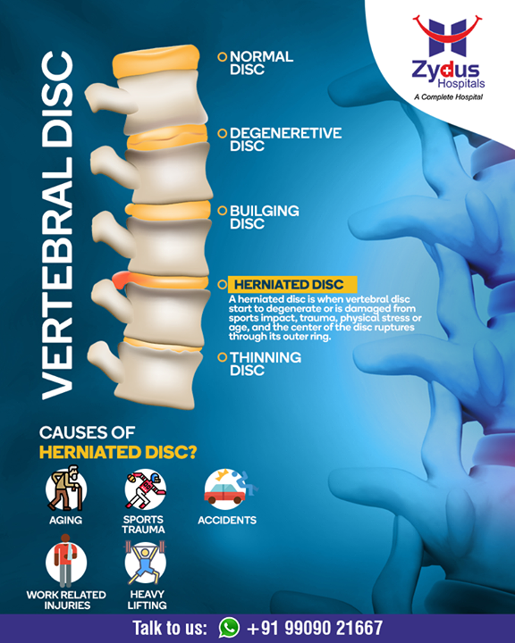 A herniated disc is when #vertebral disc start to degenerate or is damaged from #sports impact, trauma, #physical stress or #age and the center of the disc ruptures through its outer ring.

#HerniatedDisc #StayHealthy #ZydusCare #ZydusHospitals #Ahmedabad #Gujarat