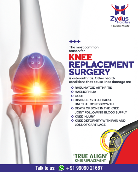 The most common reason for knee replacement surgery.

#kneereplacementsurgery #kneesurgery #kneereplacement #jointreplacement #truealignkneesurgery #StayHealthy #ZydusCare #ZydusHospitals #Ahmedabad #Gujarat