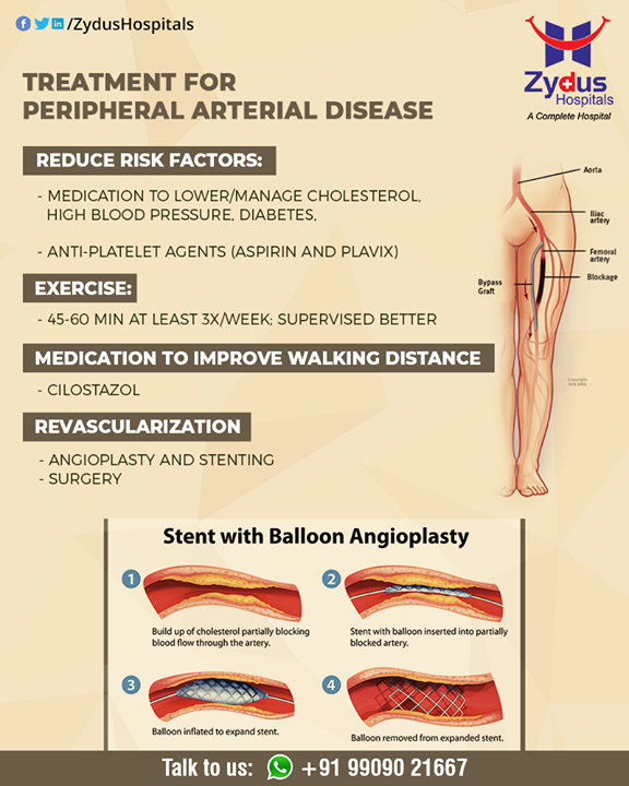 Treatment for peripheral artery disease (PAD) focuses on reducing symptoms and preventing further progression of the disease.

#PeripheralArteryDisease #BloodVessels #ZydusHospitals #HealthCare #ZydusCare #Ahmedabad