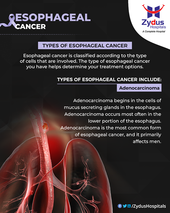 #Adenocarcinoma #TypeOfEsophagealCancer #EsophagealCancer #CancerCentre #ZydusCancerCentre #CancerCare #ZydusCare #ZydusHospitals #Ahmedabad #Gujarat