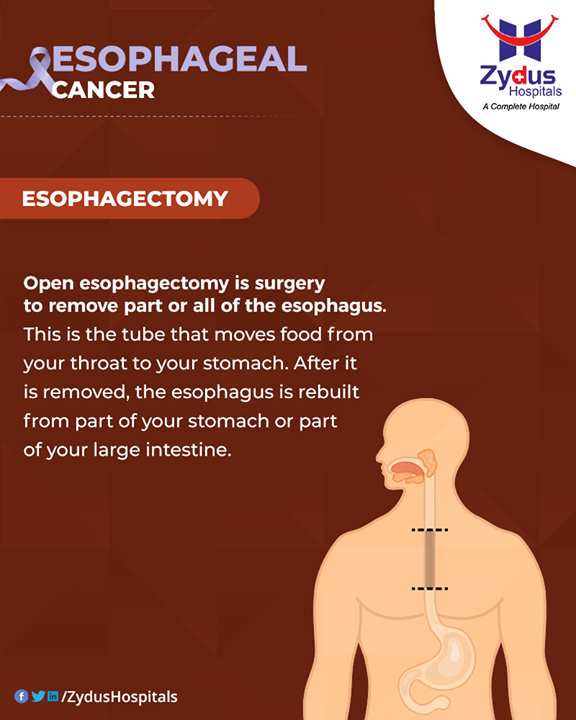Esophagectomy is the main surgical treatment for esophageal cancer. It is done either to remove cancer or to relieve symptoms.

#Esophagectomy #EsophagealCancer #CancerCentre #ZydusCancerCentre #CancerCare #ZydusCare #ZydusHospitals #Ahmedabad #Gujarat