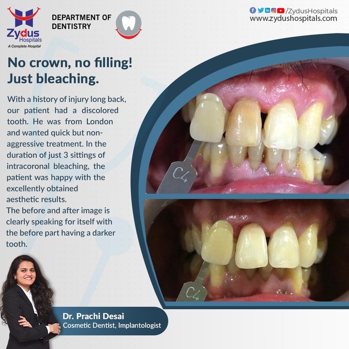 Intracoronal bleaching is a simple, useful procedure for restoring the colour of the discoloured teeth. Without the requirement of a crown or filling, one can obtain excellent results and brighter teeth.
Dr.Prachi Desai

#ZydusHospitals #Dentistry #Dentist #IntracoronalBleacing #BleachingTeeth #BrighterTeeth #DentistTreatment #HealthCare #StayHealthy #ZydusCare #Ahmedabad #Gujarat #BestHospitalinAhmedabad