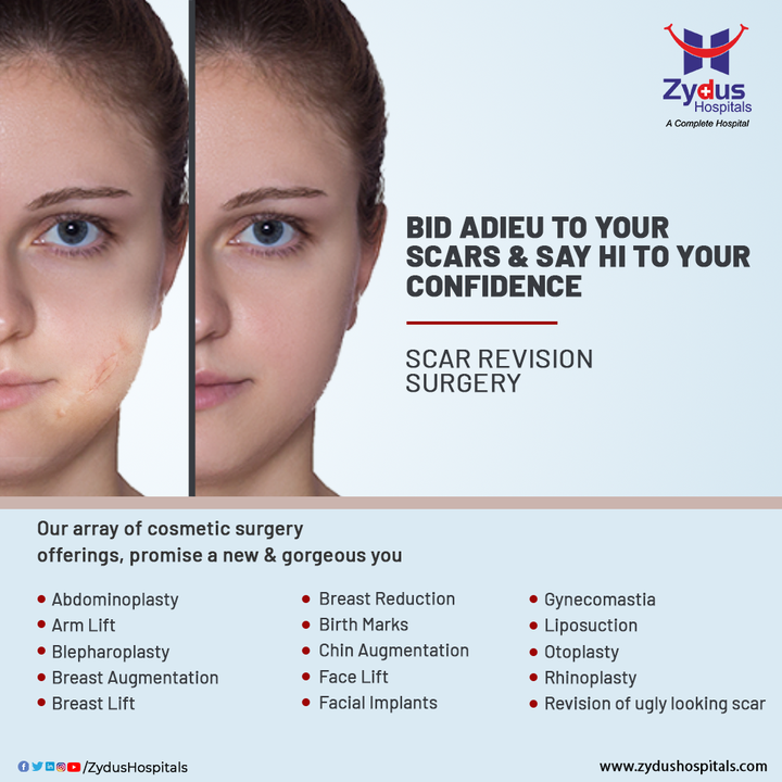 When the skin heals after an injury, it leaves a scar and some of the scars are by birth. Your desire to have a spotless skin should not be affected by that one scar, that you hide from everyone. Feel more confident in your own skin with Scar Revision Surgery which blends it in with the surrounding skin tone and texture.

Zydus Hospitals offer a wide range of cosmetic surgeries like Scar Revision, Abdominoplasty, Breast Lift, Liposuction etc. with world-class technology & our expert plastic surgeons, you don't need to second guess your decision.

#CosmeticSurgery #Surgery #Scar #ScarRemoval #Skin #Implant #Liposuction #Hospital #Health #ZydusHospitals #HealthCare #StayHealthy #ZydusCare #Ahmedabad #Gujarat #BestHospitalinAhmedabad