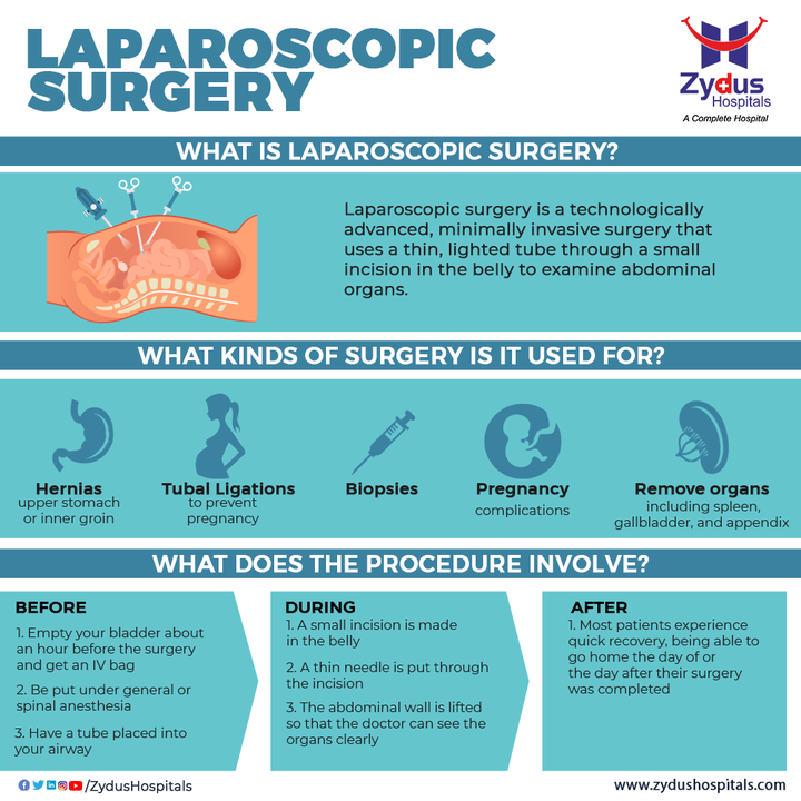 Laparoscopic surgery has demonstrated better quality-of-life outcomes than open surgery, along with offering minimal invasion. The invention of laparoscopy has proved to be a relief to the patients as well, as it offers quick recovery. This procedure is used to identify & examine the organs inside your abdomen as the doctor can see inside your body in real time. 

#LaproscopicSurgery #Laproscopy #Surgery #Abdomen #Hernia #Biopsy #Pregnancy #Appendix #MinimallyInvasiveSurgery #Surgeon #Hospital #Health #ZydusHospitals #HealthCare #StayHealthy #ZydusCare #Ahmedabad #Gujarat #BestHospitalinAhmedabad