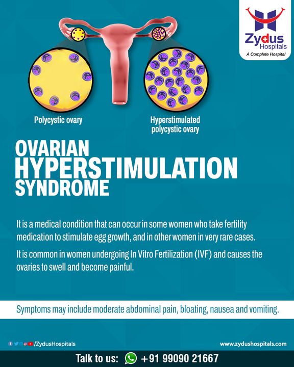 Ovarian Hyperstimulation Syndrome (OHSS) is a response to excess hormones and may occur in women undergoing IVF or ovulation induction with injectable medications. The size of the ovary is a marker of the degree of OHSS and Women experiencing OHSS have vomiting problems and can't keep down liquids. This disease can become serious & hence managing & monitoring it on a daily basis becomes necessary.

#ZydusHospitals #OvarianHyperstimulationSyndrome #OHSS #Hormones #IVF #Ovary  #Infertility #WomensInfertility #Pain #Gynecology #ReproductiveHealth #Health #HealthCare #HealthyHeart #StayHealthy #ZydusCare #Ahmedabad #Gujarat #BestHospitalinAhmedabad