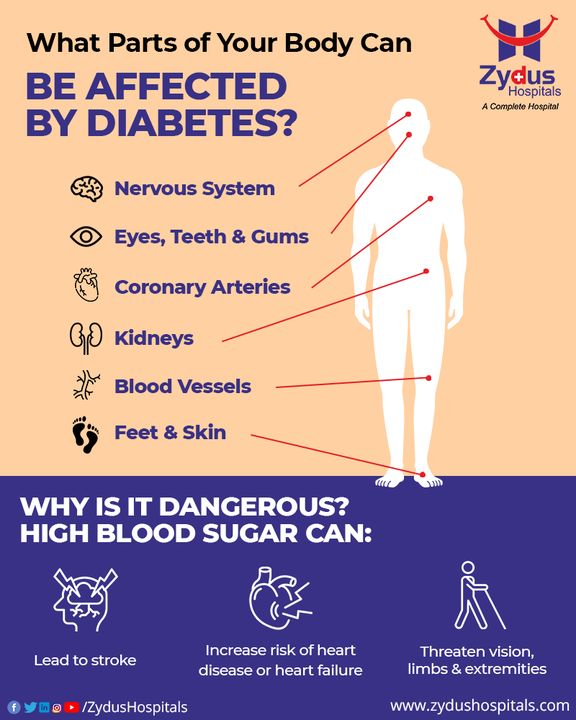 Wondering what parts of your body can be affected by diabetes?

The answer is clear and evident that it affects your entire body. Whether it is the tissues or organ systems; diabetes spreads like a slow poison damaging your body while putting your life at risk.

Waste no more time in finding excuses to delay the screening. Visit the experts and get yourself detected to be treated.

#DiabetesKills #DiabetesIsDangerous #BloodSugarControl #Insulin #LifeIsPrecious #PreventionIsTheKey #ZydusHospitals #StayHealthy #ZydusCare #BestHospitalinAhmedabad #Ahmedabad #GoodHealth