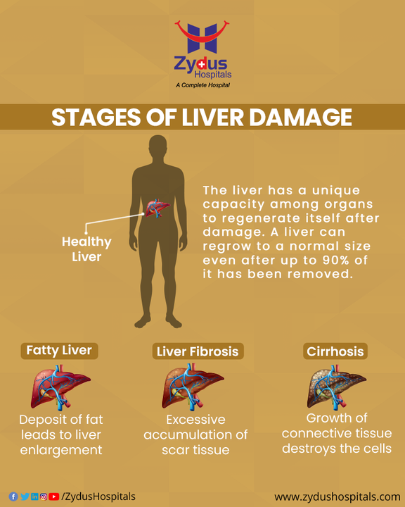 Liver is the only visceral organ that has the capacity to get regenerated. The liver can regenerate after either surgical removal or chemical injury. It is known that as little as 10% of the original liver mass can regenerate back to its full original size.

Take a closer look at the stages of liver damage and understand the importance of getting treated at the correct time.

#Liver #LiverDamage #LiverTransplant #LiverDiseases #FattyLiver #LiverFibrosis #Cirrhosis #LiverRegeneration #ZydusHospitals #BestHospital #Ahmedabad #Gujarat