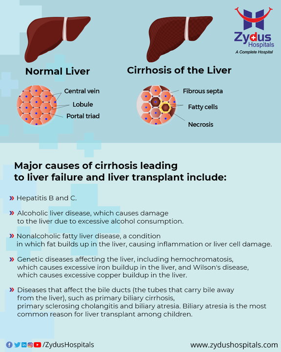 Each time your liver gets injured whether by disease or by excessive alcohol consumption or by another causes, it tries to repair itself. In the process, scar tissue get formed.

Cirrhosis is a late stage of scarring (fibrosis) of the liver caused by many forms of liver diseases and conditions, such as hepatitis B & C and chronic alcoholism. The liver damage done by cirrhosis generally cannot be undone but if liver cirrhosis is diagnosed early and the cause is treated, further damage can be limited and rarely reversed.

Reduce your risk of cirrhosis by taking the following liver care steps:

- Do not drink alcohol 
- Choose a plant-based diet that's full of fruits and vegetables
-  Select whole grains and lean sources of protein
- Reduce the amount of fatty and fried foods you eat
- Maintain a healthy weight
- Talk to your doctor about a weight-loss plan if you are obese or overweight
- Reduce your risk of hepatitis

#Liver #LiverCare #LiverCirrhosis #LiverDamage #LiverTransplant #LiverTransplantation #LiverDiseases #FattyLiver #LiverFibrosis #Cirrhosis #LiverRegeneration #ZydusHospitals #BestHospital #Ahmedabad #Gujarat