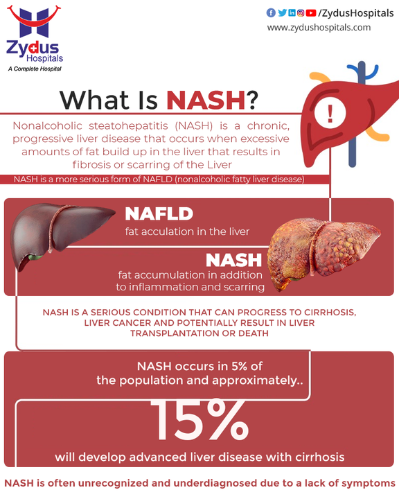 NASH stands for Non-Alcoholic SteatoHepatitis! NASH is a modern & progressive lifestyle disease that gets heavily influenced by the lifestyle. 

It is often defined as the liver manifestation of a metabolic disorder and is believed to be the most severe form of non-alcoholic fatty liver disease (NAFLD). NASH is closely related to the triple epidemic of obesity, pre-diabetes, and diabetes but its symptoms are often silent or non-specific to NASH. It is quite difficult to get diagnosed.

We highly recommend you to lead an active and healthy lifestyle in-order to stay away from the complicated diseases. Remember that your life is precious not only for yourself but also for your family members.

#NASH #NonAlcoholicSteatoHepatitis #NAFDL #Liver #LiverCare #LiverCirrhosis #LiverDamage #LiverTransplant #LiverTransplantation #LiverDiseases #FattyLiver #LiverFibrosis #Cirrhosis #LiverRegeneration #ZydusHospitals #BestHospital #Ahmedabad #Gujarat