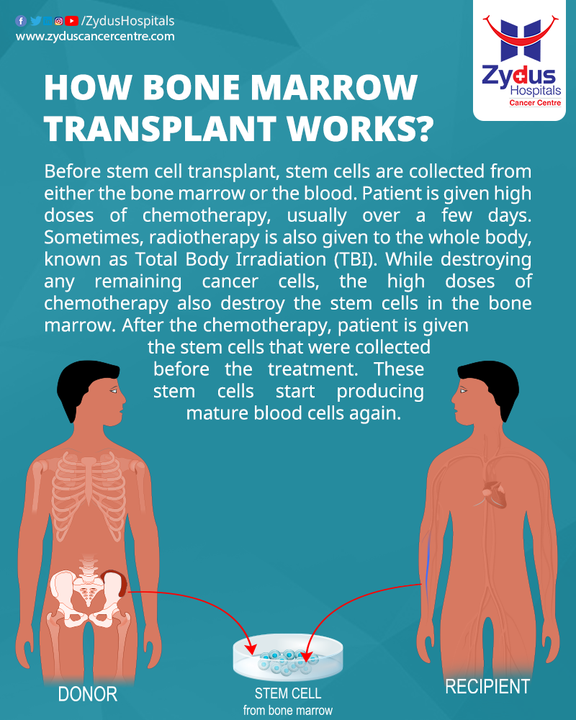 By being a donor of bone marrow stem cell, you can re-fill the missing part in someone's life!

A bone marrow transplant is also called a stem cell transplant which is a procedure that infuses healthy blood-forming stem cells into the body to replace damaged or diseased bone marrow. It is often found to be the best treatment option for patients with leukemia, lymphoma, sickle cell anemia, thalassemia, immune deficiencies & many other diseases.

Being a pioneer and a centre of excellence in the field of bone marrow transplant, at Zydus Cancer Centre, we have a multidisciplinary team of doctors working together on a case-by-case basis to treat each patient and offer compassionate care. 

For an opinion, book appointment today!

#BoneMarrowTransplant #FillTheGap #BoneMarrowStemCell #StemCellDonors #BeADonor #SaveLife #OrganTransplant #CancerCare #Leukemia #BloodCancer #RBC #ZydusCancerCentre #ZydusHospitals #ZydusCare #BestHospitalInAhmedabad #Gujarat