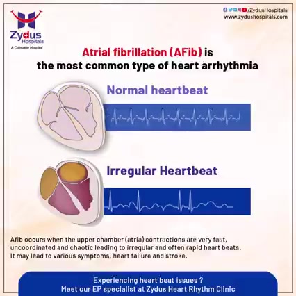 There are many people who have been suffering with the consequences of atrial fibrillation without having much knowledge and information about the same. Atrial fibrillation (AFib) is an irregular and rapid heart beat that occurs when the two upper chambers of heart experience chaotic electrical signals. It is one of the most common type of heart arrhythmia.

Right diagnosis and treatment are essential because a little carelessness can be very fatal.

#ZydusHospitals #Atrialfibrillation #HeartBeat #HealthCare #StayHealthy #ZydusCare #Ahmedabad #Gujarat #BestHospitalinAhmedabad #SmileofGoodHealth #Heartcare #Cardiology #EPStudy #Electrophysiology #ElectrophysiologyStudy