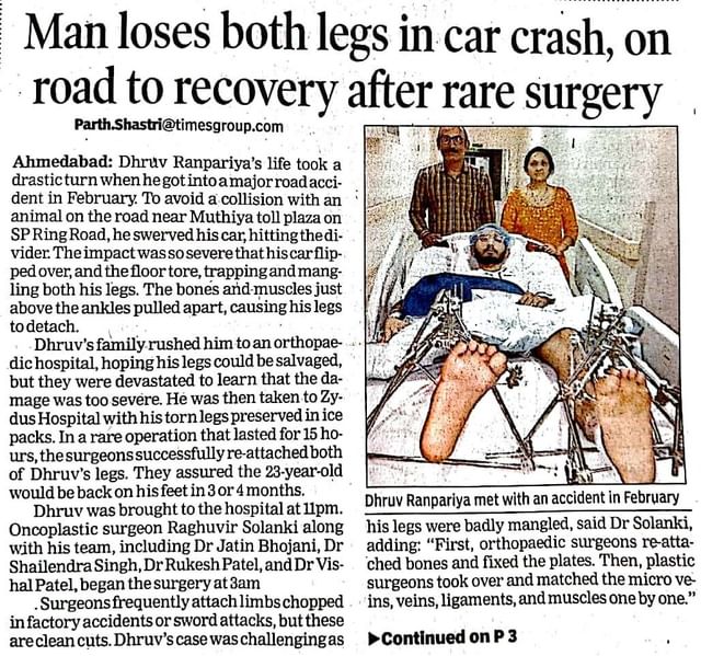 In a horrific car accident, 23-year-old Dhruv lost both of his legs back in the month of February. His journey of reaching Zydus after the crash and our expert doctors' efforts in ensuring his recovery over the past couple of months has been nothing short of miraculous! 

This herculean surgical task was pulled off by Dr. Raghuvir Solanki along with his team, Dr. Jatin Bhojani, Dr. Shailendra Singh, Dr. Rukesh Patel & Dr. Vishal Patel, who made sure both of his legs were attached back to his body and all vital connections were established in order to restore function completely by the end of the journey!

#InTheNews #TOI #HopeAndHealth #Recovery #MiraculousRecovery #Crash #DoubleReplantation #SurgicalMiracle #ComprehensiveCare #PatientCare #JourneyOfMotherhood #QualityHealthcare #HealthCare #Zydus #ZydusCare #ZydusExperts #ZydusHospitals #BestHospitalinAhmedabad #ZydusHospitalsAhmedabad #AhmedabadHospitals #Ahmedabad #Gujarat