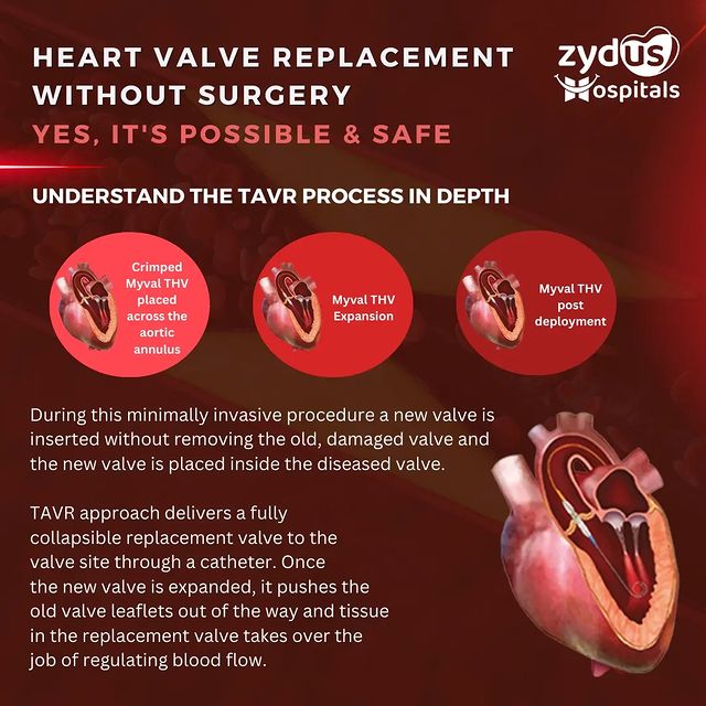 Understand the TAVR (Transcatheter Aortic Valve Replacement) procedure - what it is & how it works, and witness the advancements in cardiac care.

#cardiology #heartattack #arterydisease #healthyheart #cardiacarrest #cardiacsurgery #cardiac #healthyheart #heartdisease #TAVI #TAVR #heartdiseaseawareness #heartdiseaseprevention #Healthcare #Zydus #ZydusExperts #ZydusCare #ZydusHospitals #BestHospitalinAhmedabad #ZydusHospitalsAhmedabad #Ahmedabad #Gujarat