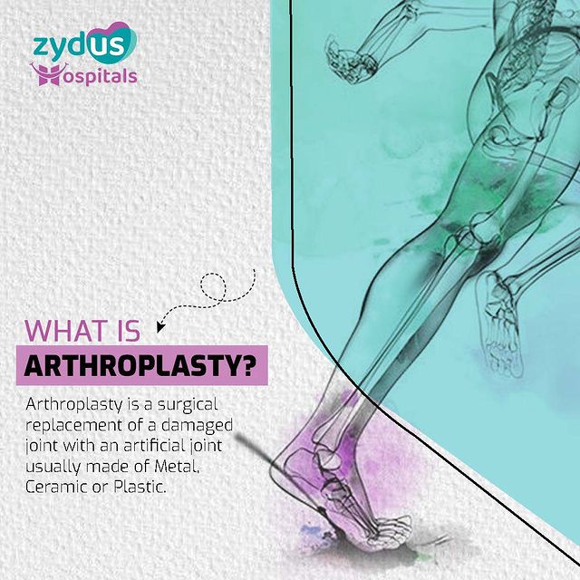 Regular exercise is the mantra for living a healthy life. However, joint pain can have an impact on our way of life. But should anything prevent us from living an active and healthy life? Well, it is possible to get back to a healthy lifestyle by surgically replacing damaged joints with an artificial joints made of metal, ceramic, or plastic.
At Zydus Hospital, we have a team of proficient experts who utilize state-of-the-art technology to carry out arthroplasty procedures with unparalleled precision, all under one roof.
.
.
.
.
.
.
.
.
.

.#HealthyLifestyle #JointPainNoMore #ActiveLife #ArthroplastyExperts #PrecisionSurgery #ZydusHospitalAdvantage #CuttingEdgeTechnology #StateOfTheArtFacilities #ExpertSurgeons #MetalJoints #CeramicJoints #PlasticJoints #QualityCare #SeamlessRecovery #JointReplacement #PainRelief #HealthcareExcellence #AdvancedMedicalProcedures #GetBackInMotion #LifesavingSurgery #ZydusMedicalBreakthrough