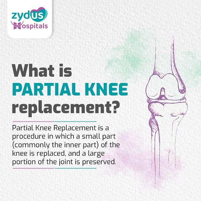 Close your eyes and imagine a day without knee pain, Or Imagine yourself dancing like no one's watching. Let's make it happen! 

At Zydus Hospitals, we understand the significance of preserving your knee health and well-being. Our commitment lies in facilitating a swifter recovery and providing lasting relief through our expertise in Partial Knee Replacement. 

This approach allows us to conserve as much of your natural joint as possible, giving you the chance to embrace an active and joyful future without being weighed down by discomfort. So, let's work together to make this vision a reality.
.
.
.
.
.
.
.
.
.
#ImagineNoKneePain #DancingWithJoy #KneeHealth #ZydusHospitals #ExpertiseInPartialKneeReplacement #SwifterRecovery #LastingRelief #NaturalJointConservation #ActiveLifestyle #KneeWellBeing #HealthAndWellness #EmbraceTheFuture #PainFreeLiving #JointHealth #KneeCare #JointPreservation #HealthcareExpertise #ZydusHealthcare #LeadingMedicalCare #HealthcareCommitment #JointHealthAndWellness #ActiveFuture #KneeRelief #UnlockYourMobility #ZydusPride #HealthcareQuality #JointHealthMatters