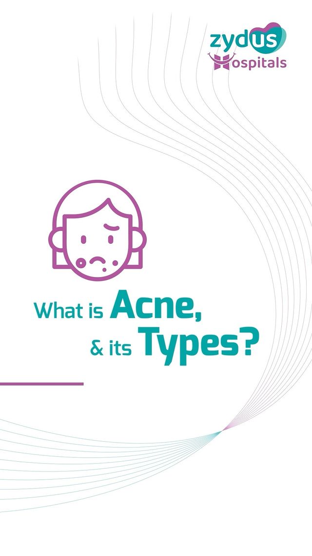 Listen to Zydus Hospitals' Dermatologist and Cosmetologist, Dr. Dhwani Shah, talk about acne and the factors that lead to its development, mostly on the cheeks. In this video, she also explains the four different types of acne grades and their respective treatments.

#DermatologyInsights #AcneAwareness #SkinCareTalk #DermatologyTips #ZydusHealthTalks #Cosmetology101 #CheekAcne #AcneGrades #DermatologistAdvice #SkinHealthMatters #ZydusWellness #BeautyTalks #SkincareEducation #HealthySkinJourney #AcneTreatment #DermatologyUpdates #ZydusExperts #SkinCareRoutine #DhwaniShah #ZydusHealthcare #BeautyWellness #SkinIssues #DermatologyClinic #SkinHealthTips #AcnePrevention