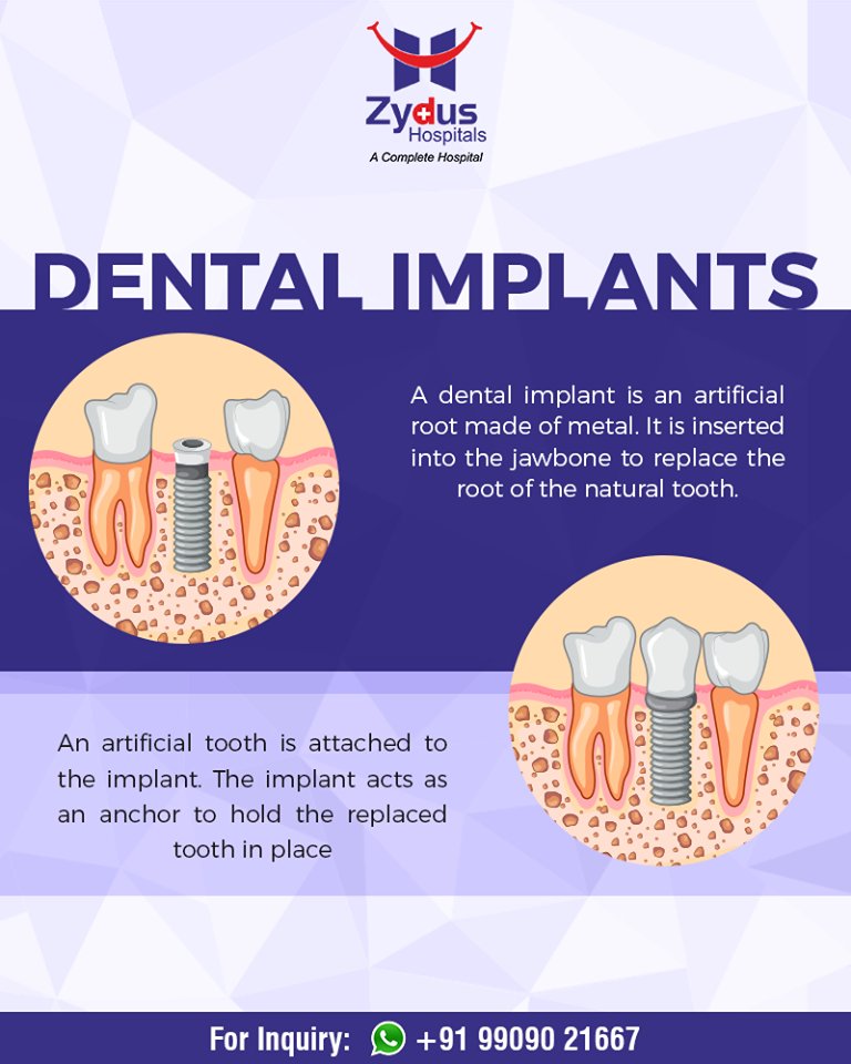 All that you wanted to know about #DentalImplants! 

#ZydusHospitals #StayHealthy #Ahmedabad #GoodHealth #DentalHealth https://t.co/PxSP1H66Qy