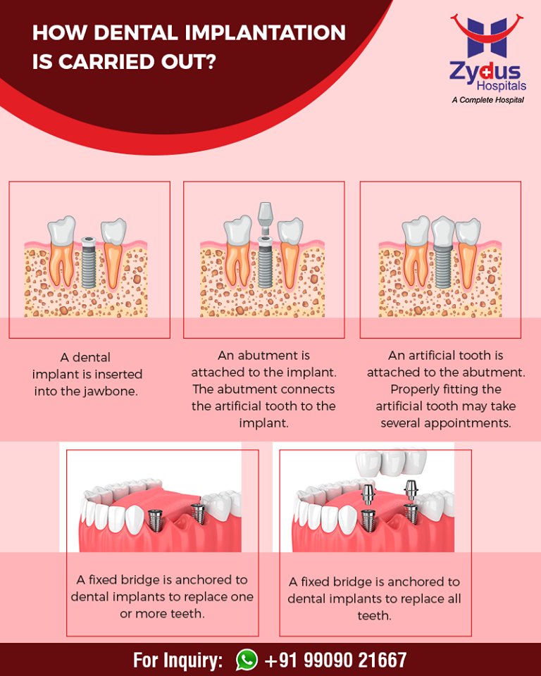 All you wanted to know about #dentalimplants! 

#ZydusHospitals #StayHealthy #Ahmedabad #GoodHealth #DentalHealth https://t.co/yhbxTgpv1x