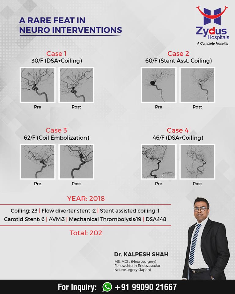 A rare feat in neuro interventions! 

#ZydusHospital #Ahmedabad https://t.co/70NL7jiC2P