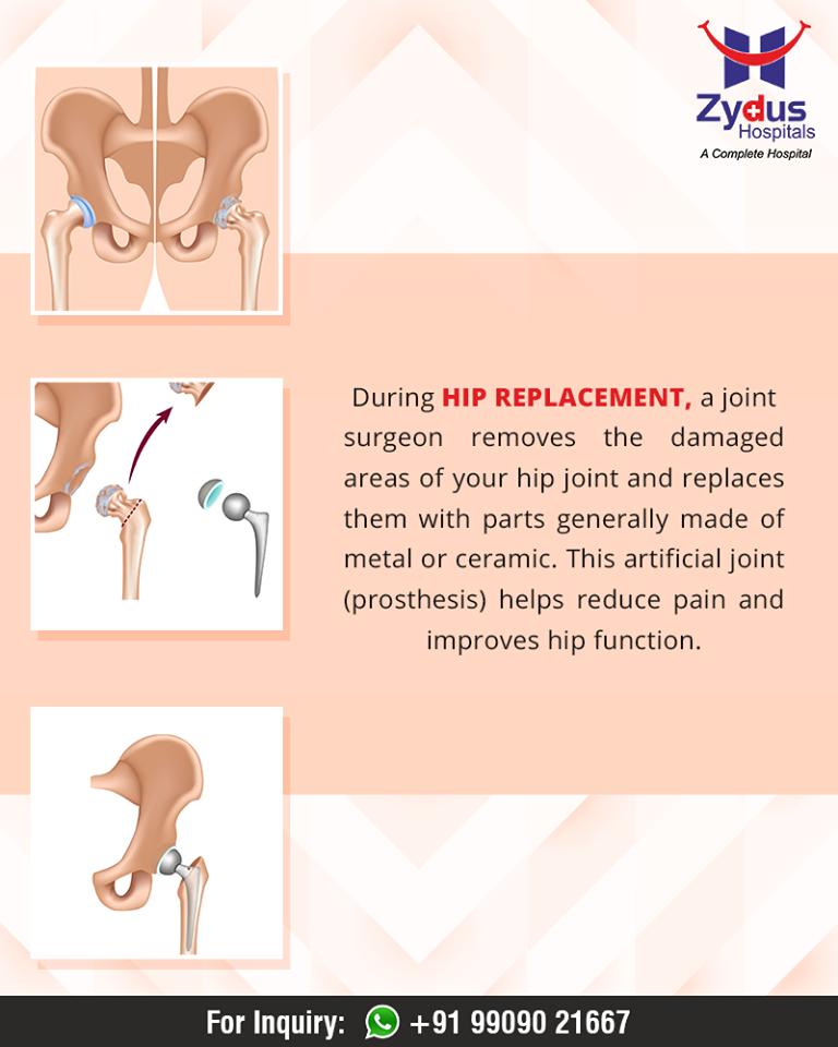 Facts about #HipReplacement!

#HumanHip #ZydusHospitals #Ahmedabad #GoodHealth #WeCare https://t.co/6fpuUTYmg4