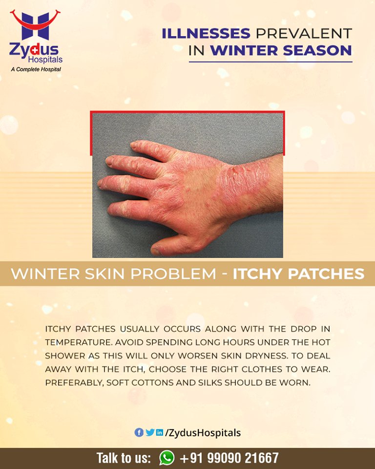 Itchy patches usually occurs along with the drop in temperature. Your skin may become scaly, bumpy, itchy, or otherwise irritated.

#WinterSkinProblem #Rash #ItchyPatches #Winter #ZydusHospitals #HealthCare #ZydusCare #Ahmedabad https://t.co/LlZ54b0kMR