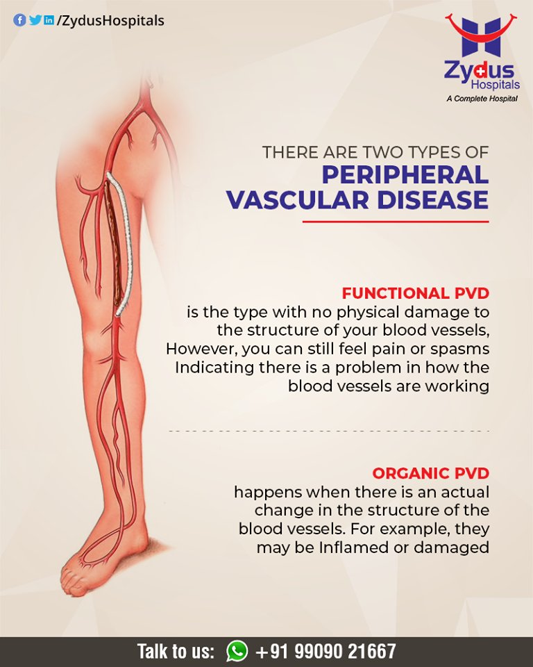 Types of peripheral vascular disease

#PeripheralVascularDisease #ZydusHospitals #HealthCare #ZydusCare #Ahmedabad https://t.co/Y6lQ4gN9qV