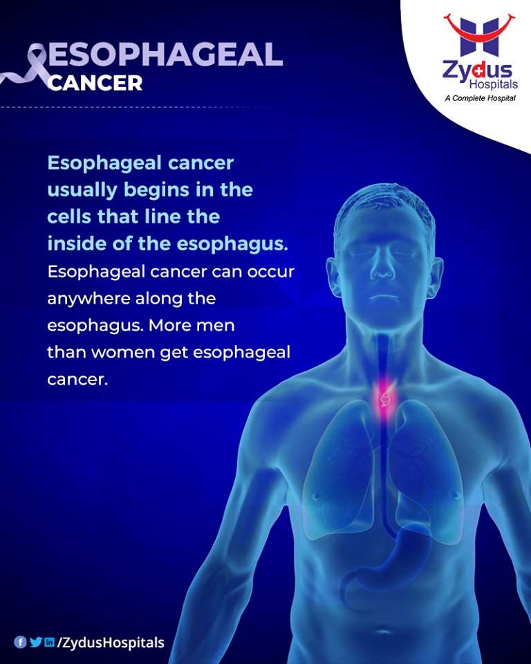 Men are more likely than women to get esophageal cancer.

#EsophagealCancer #CancerCentre #ZydusCancerCentre #CancerCare #ZydusCare #ZydusHospitals #Ahmedabad #Gujarat https://t.co/cOEVMeanMl