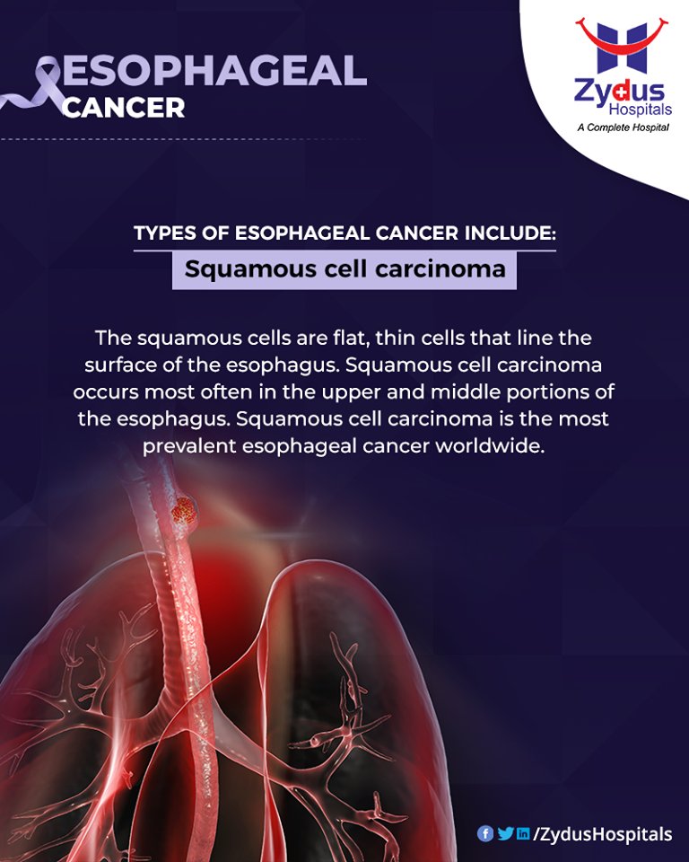 #SquamousCellCarcinoma #TypeOfEsophagealCancer #EsophagealCancer #CancerCentre #ZydusCancerCentre #CancerCare #ZydusCare #ZydusHospitals #Ahmedabad #Gujarat https://t.co/Zy2X5KaZTs