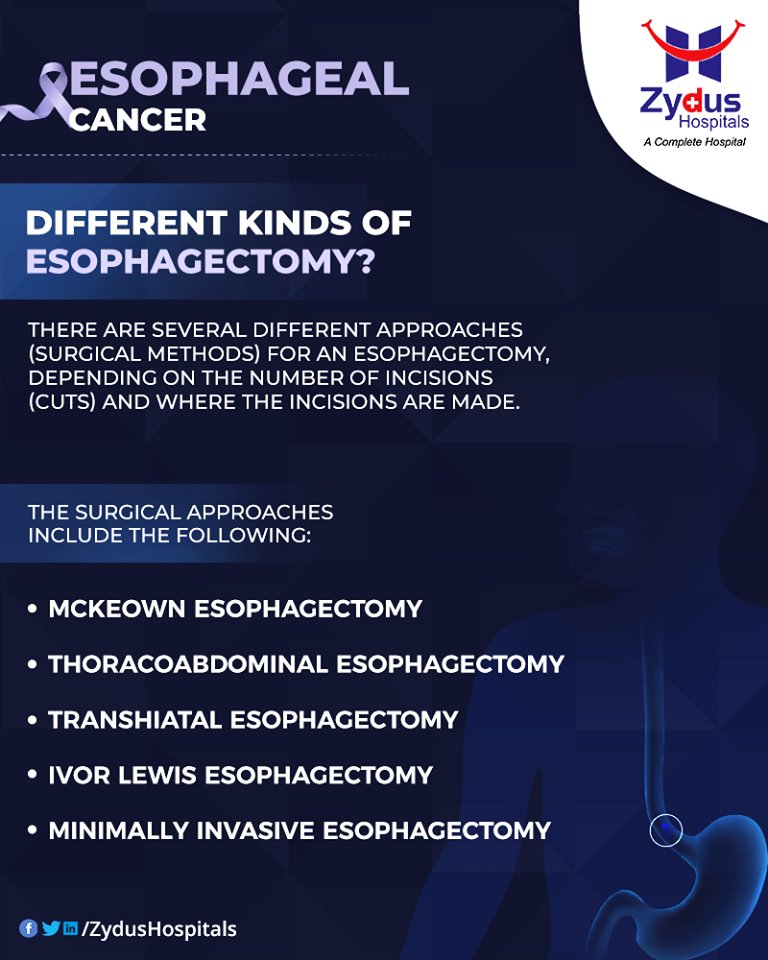 There are several different approaches (surgical methods) for an esophagectomy, depending on the number of 
ReadMore:https://t.co/jpgUWBrZM1

#Esophagectomy #EsophagealCancer #CancerCentre #ZydusCancerCentre #CancerCare #ZydusCare #ZydusHospitals #Ahmedabad #Gujarat https://t.co/zkhBC3gkI2