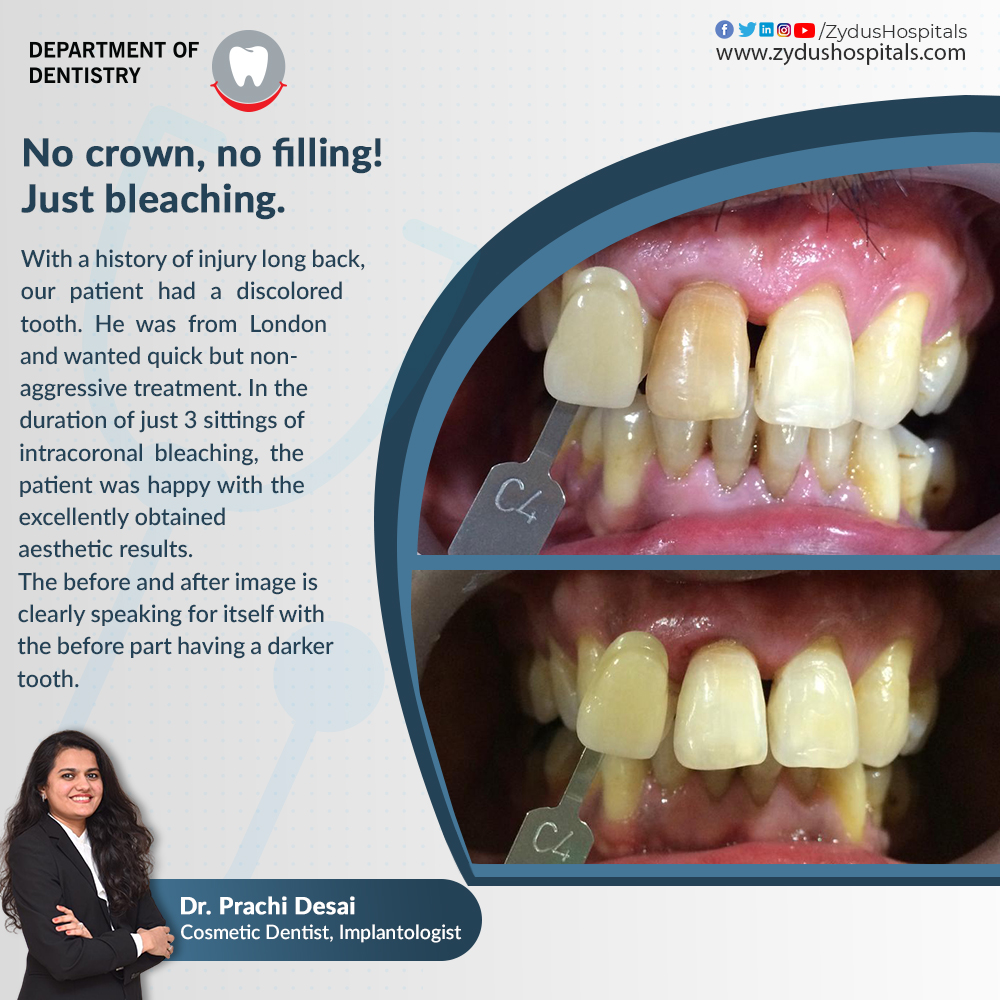 Intracoronal bleaching is a simple, useful procedure for restoring the colour of the discoloured teeth. Without the requirement of a crown or filling, one can obtain excellent results and brighter teeth.

#ZydusHospitals #Dentistry #Dentist #IntracoronalBleacing #BleachingTeeth https://t.co/6hhnFvRliN