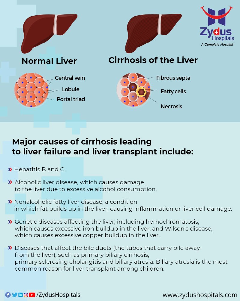 Cirrhosis is a late stage of scarring (fibrosis) of the liver caused by many forms of liver diseases and conditions, such as hepatitis B & C and chronic alcoholism.

#Liver #LiverCare #LiverCirrhosis #LiverDamage #ZydusHospitals #BestHospital #Ahmedabad #Gujarat https://t.co/GGG6CKm5ov