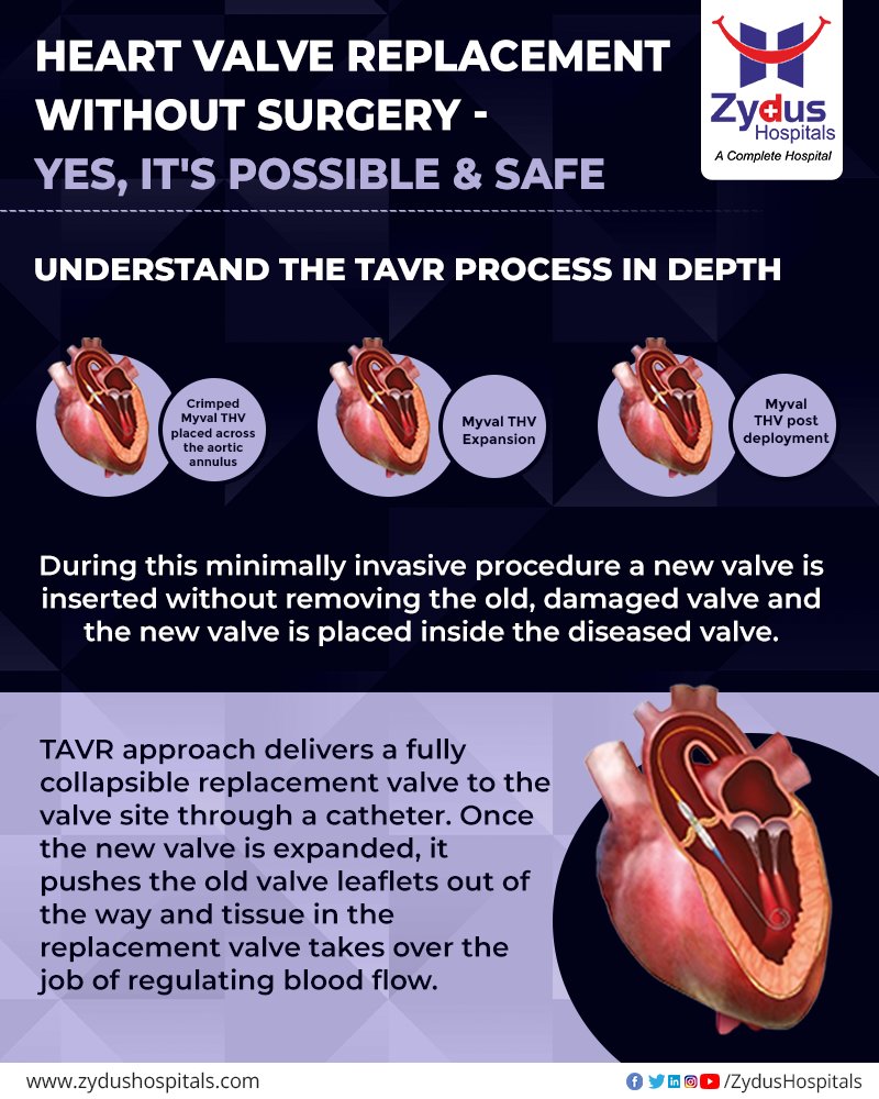Get diagnosed and detected at the right time, get your confusion and fears replaced with the excellence of medical advancement at Zydus Hospitals. 

#TAVR #TAVI #TranscatheterAorticValveReplacement #AorticStenosis #TAVRAdvantages #TAVRBenefits  #ZydusHospitals #ZydusCare https://t.co/sDGKs0gD1M