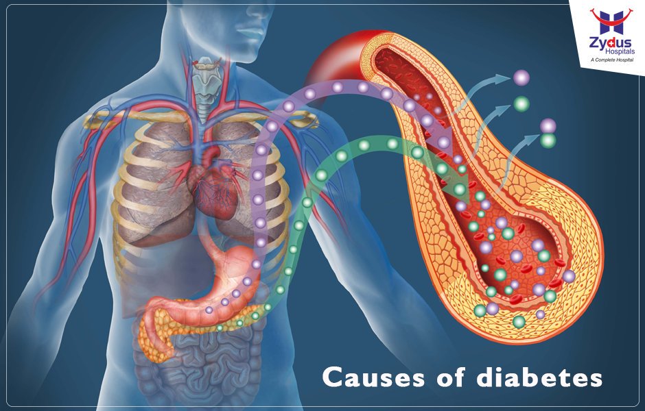 Diabetes is a group of diseases characterised by high blood glucose levels.
#Diabetes #ZydusHospitals #Ahmedabad https://t.co/Y0W4aYaEfJ
