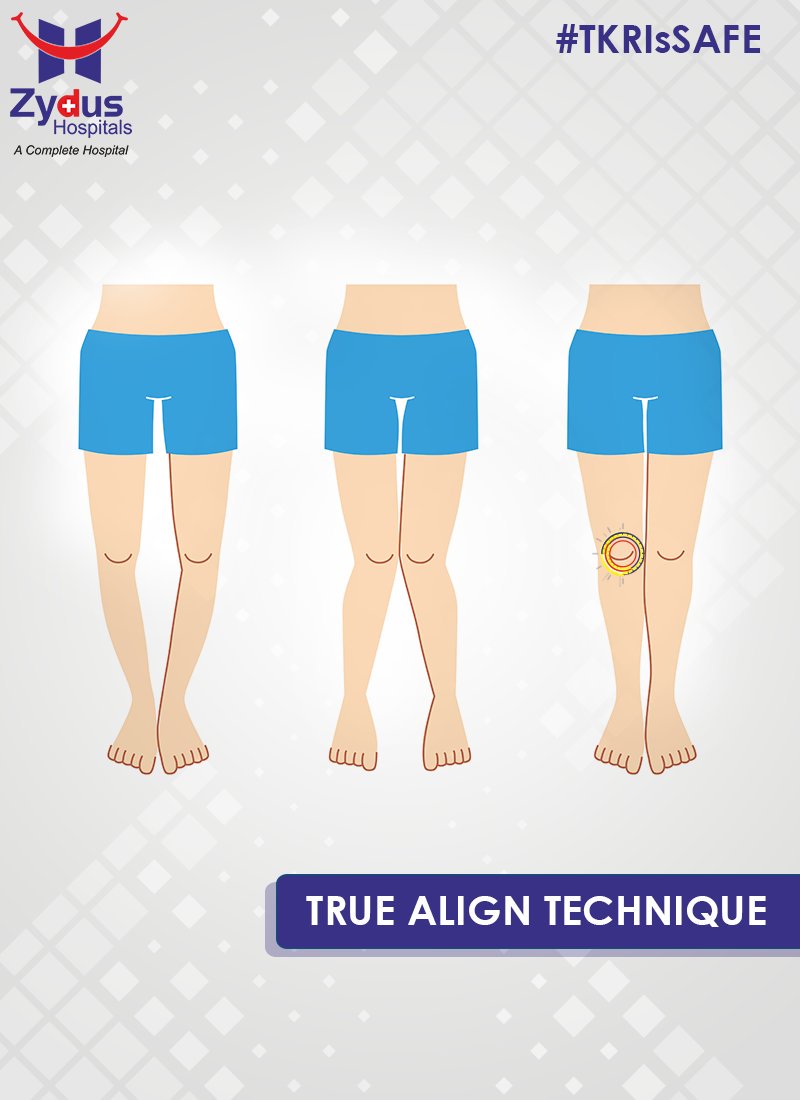True Align Technique puts you on more safer side as its focus is on 
Read More :https://t.co/cj6DsdJOIb https://t.co/bYgOrIgxBA