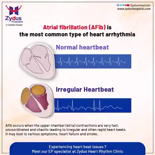 Right diagnosis and treatment are essential because a little carelessness can be very fatal.

#ZydusHospitals #HeartCare #Atrialfibrillation #HeartBeat #HealthCare #StayHealthy #ZydusCare #Ahmedabad #Gujarat #BestHospitalinAhmedabad #SmileofGoodHealth #Heartcare #Cardiology https://t.co/J9VQt34UVG